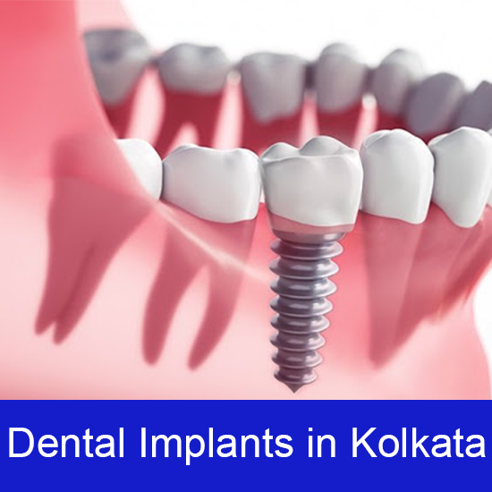 Dental Implant In Kolkata | Best Dental Implant In Kolkata | Dental Implant  Treatment In Kolkata